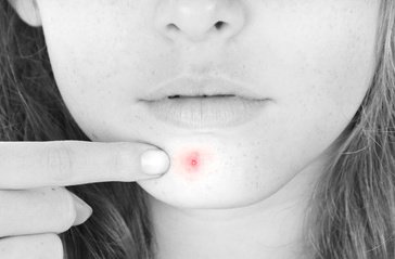 Pointing to a white head pimple on chin