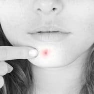 Girl pointing at pimple on chin