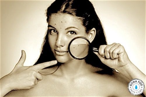 Girl holding magnifying glass to face showing pimples